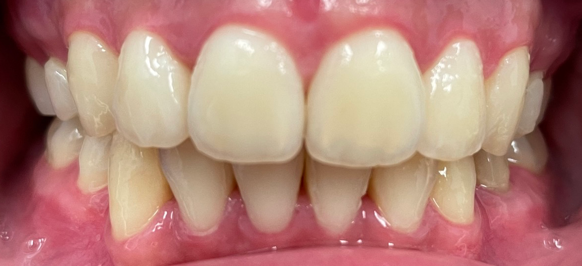 Unity Square Dental patient after clear aligners