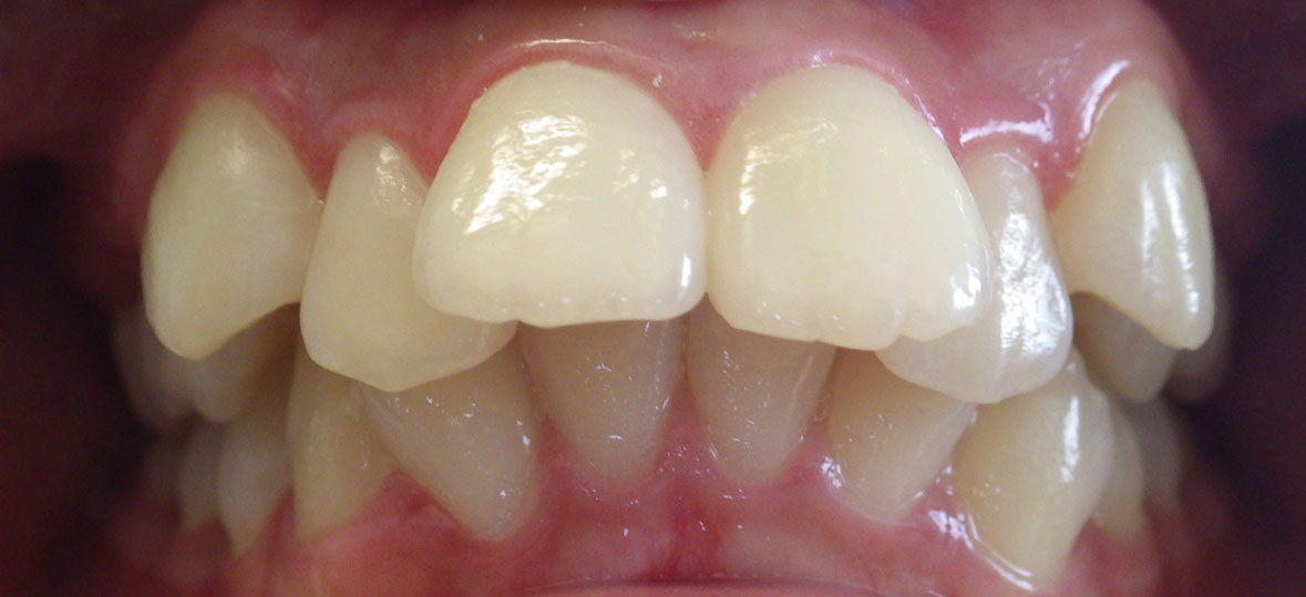 Unity Square Dental patient before aligners