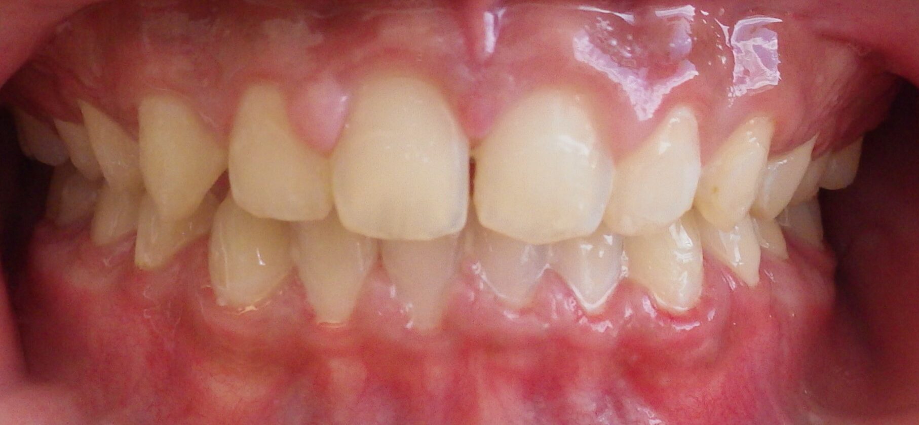 Unity Square Dental patient after braces