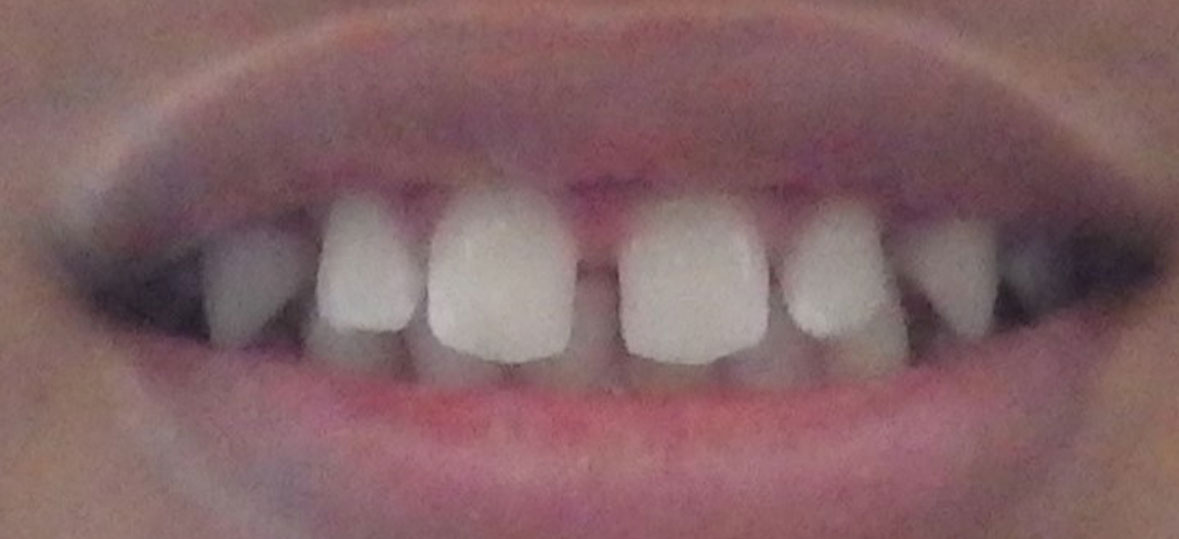 Unity Square Dental patient before braces