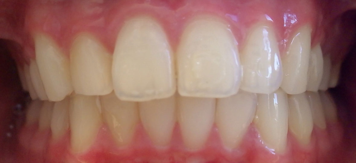 Unity Square Dental patient after braces and clear aligners