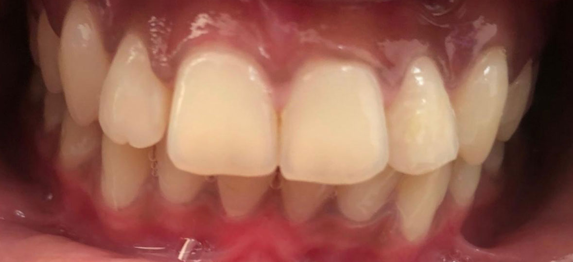 Unity Square Dental patient after braces and clear aligners