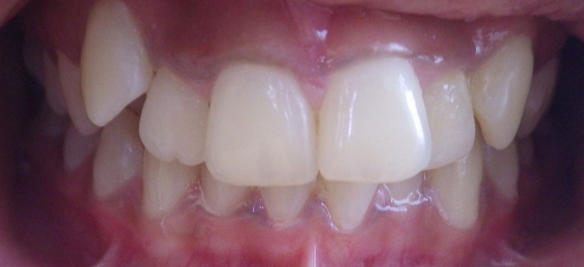 Unity Square Dental patient after braces and clear aligners