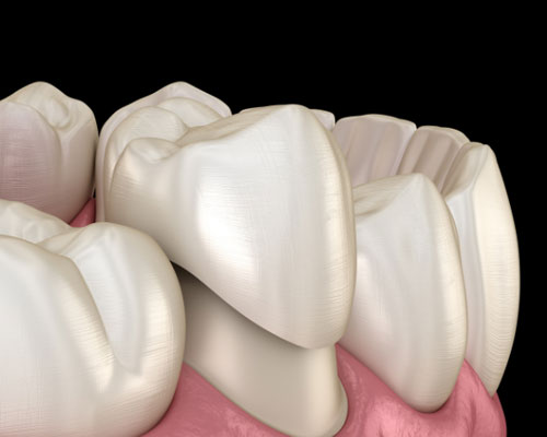 Dental Crowns in Edmonton