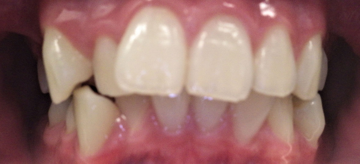 Unity Square Dental patient before braces and clear aligners