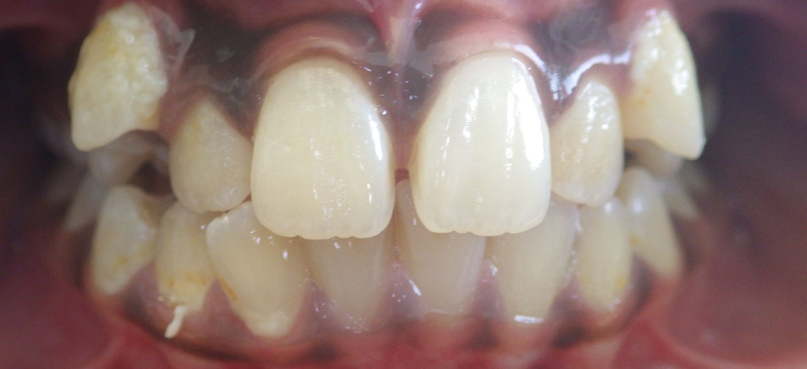 Unity Square Dental patient after braces and clear aligners