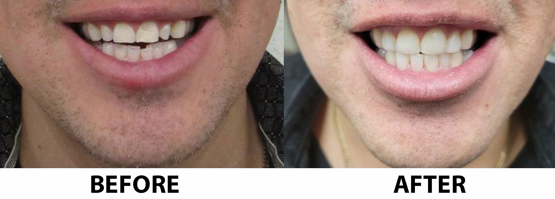 Before and After Composite veneers